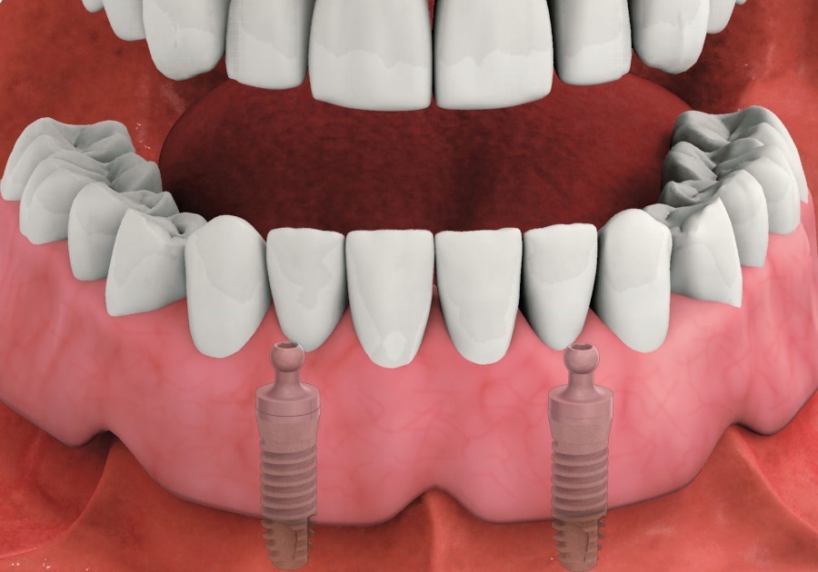 Aspen Dental Comfilytes Dentures Broughton IL 62817